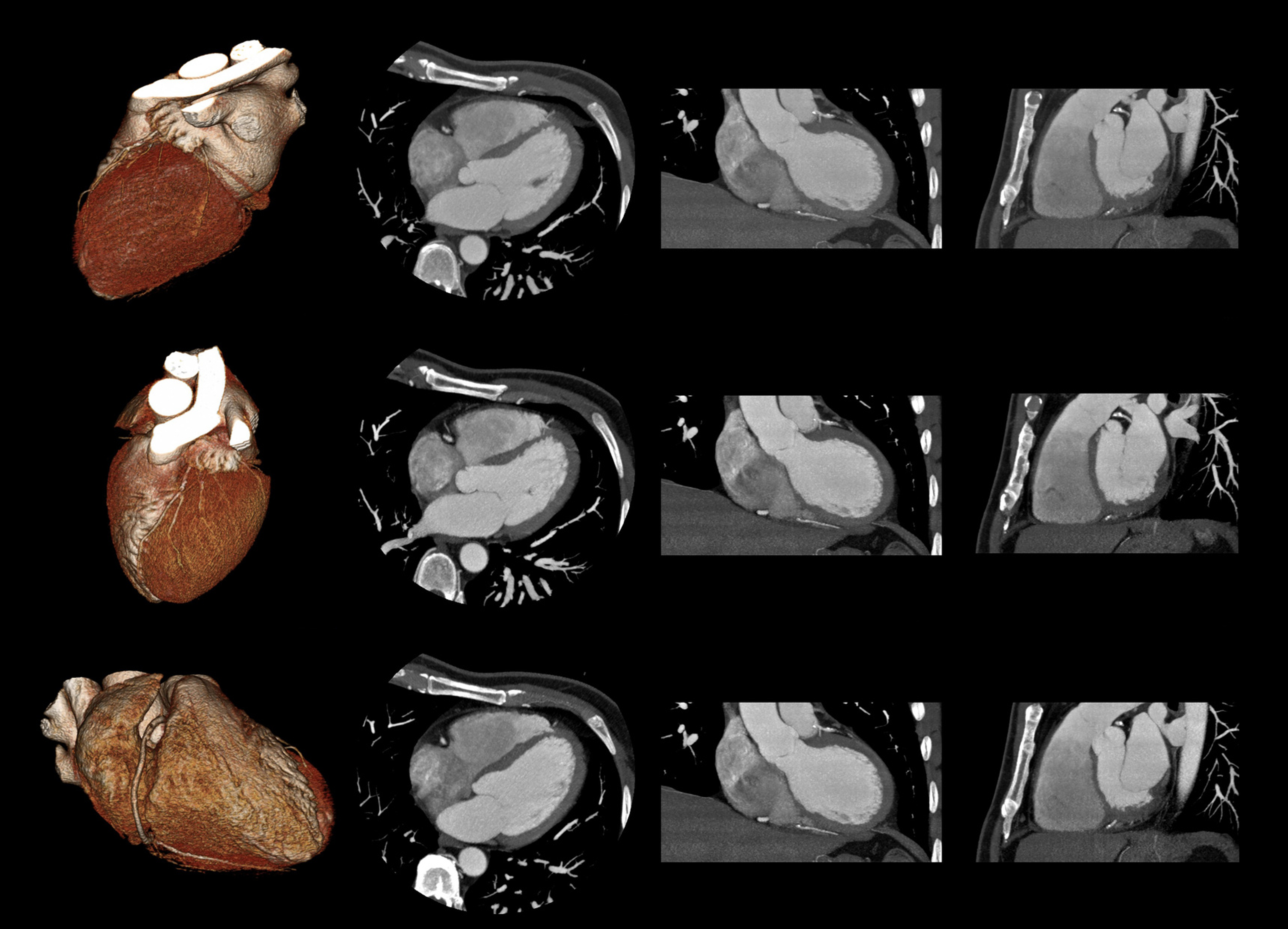 Caristo’s FDA Clearance for AI-Powered Heart Attack Prevention